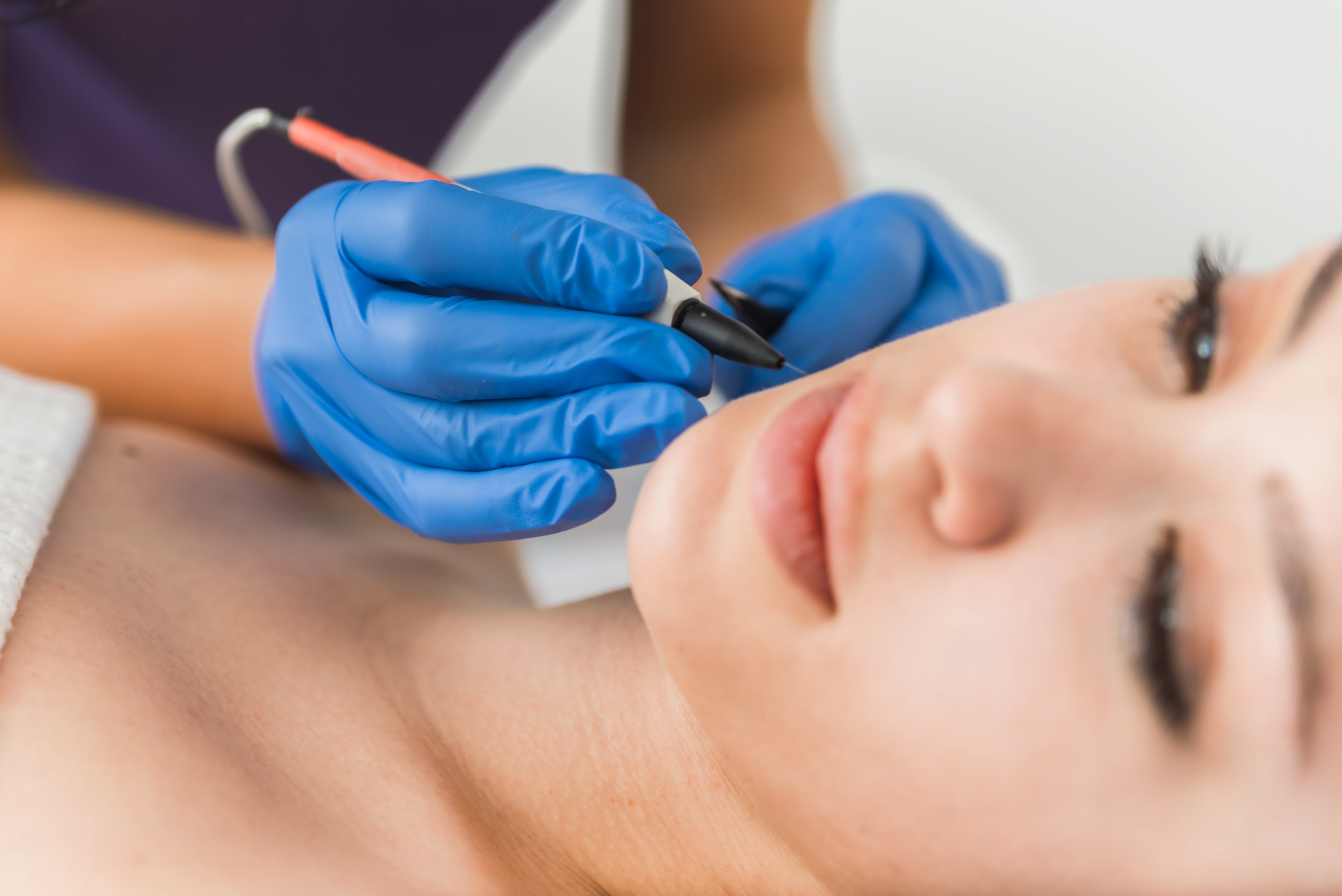 Dermatologist doing hair removal treatment on patient's face with electrolysis